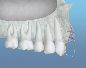 bonegraft 2