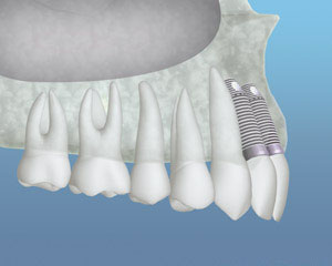 bonegraft 3