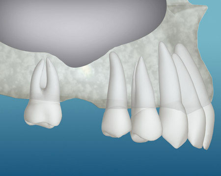 bonegraftupper 1