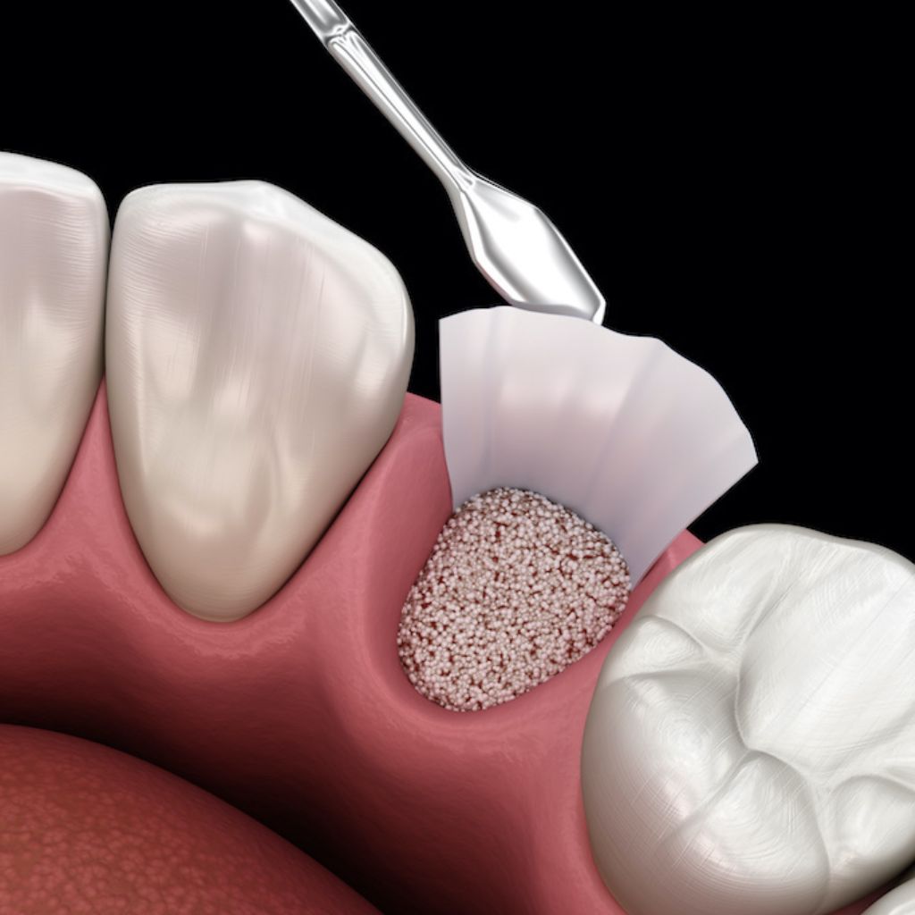 dental bone grafting