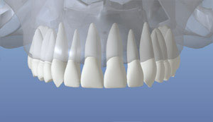 dental implant 1