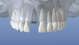 dental implant 2