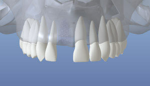 dental implant 3