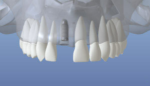 dental implant 4