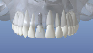 dental implant 6