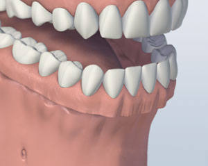 denture