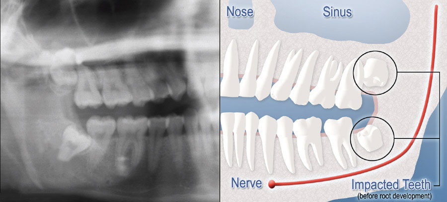 diagram of x-ray and impacted wisdom teeth
