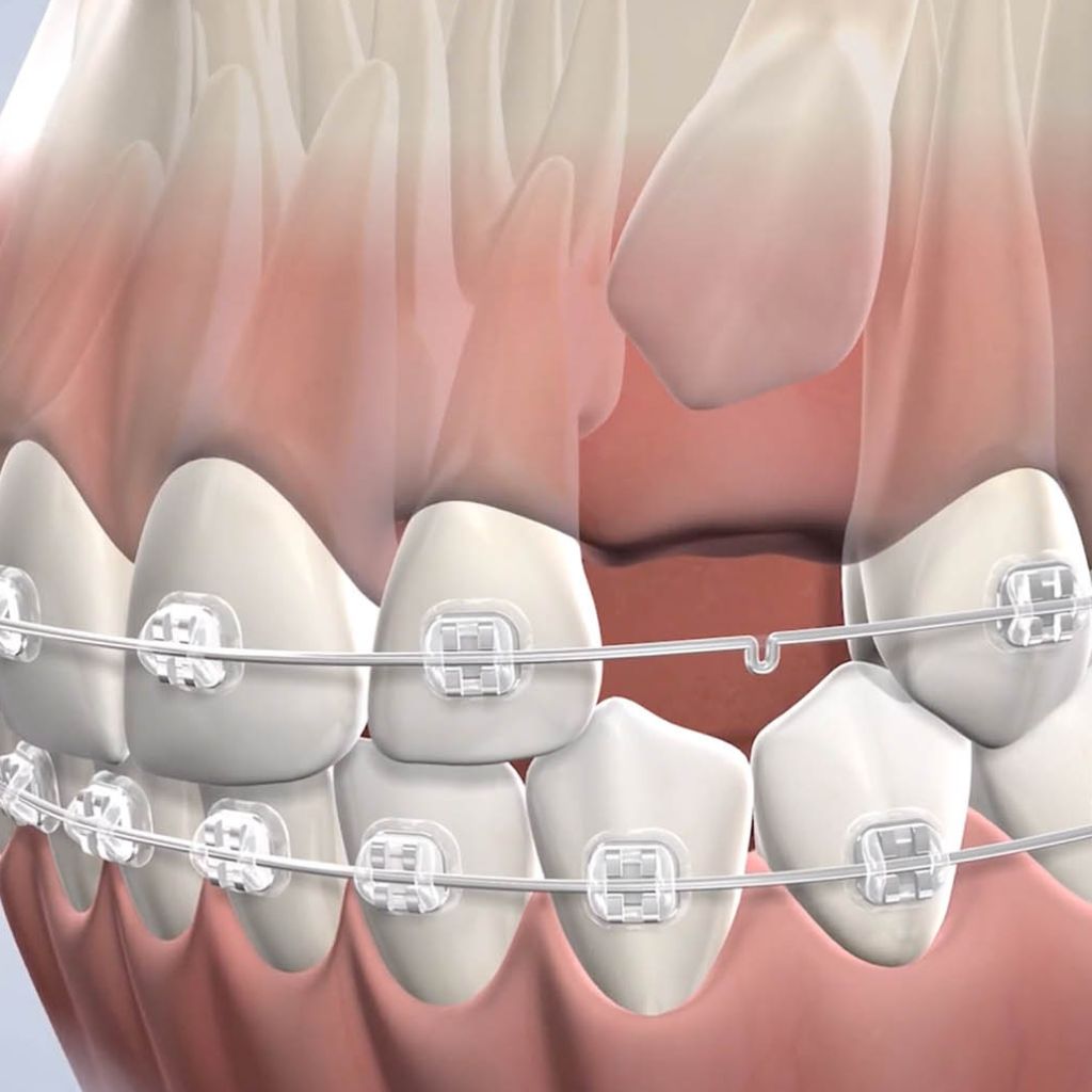 impacted canine teeth