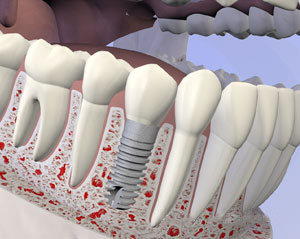 implant 1