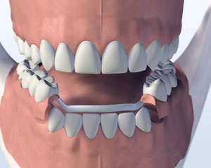 metal partial