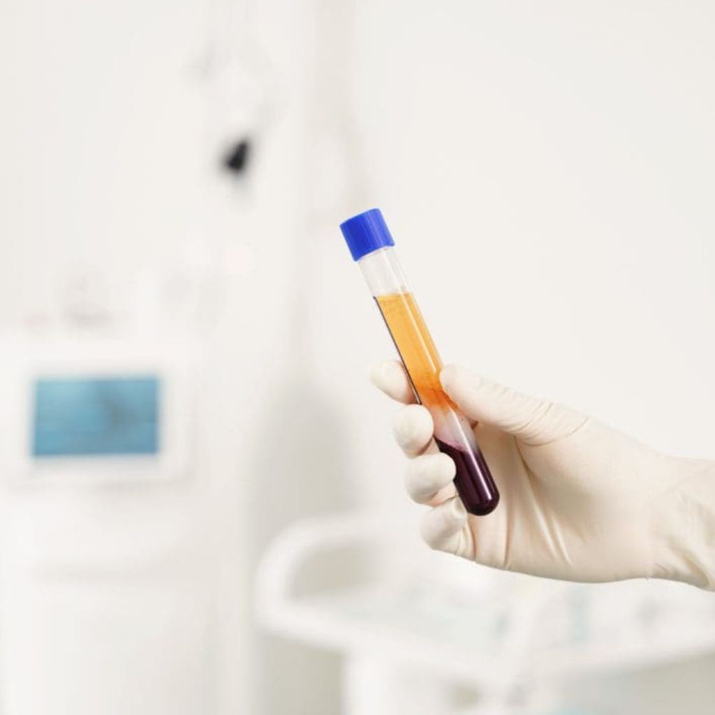 prp therapy