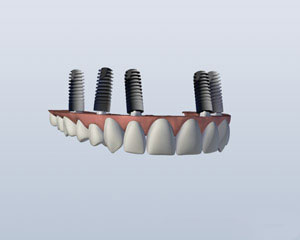 upper denture