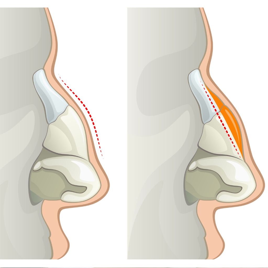 what is rhinoplasty
