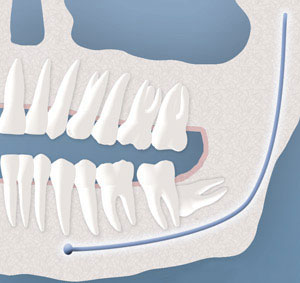 wisdom tooth complete bony impaction