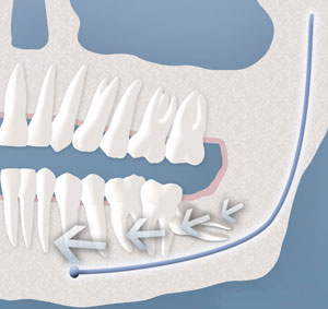 wisdom tooth crowding teeth