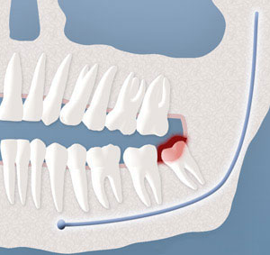 wisdom tooth infection
