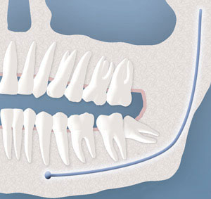 wisdom tooth partial bony impaction