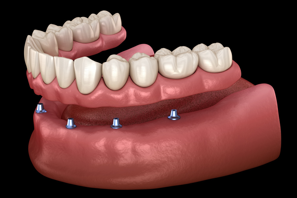 All on 6 system supported by implants