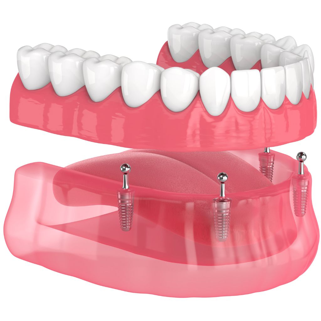 overdenture