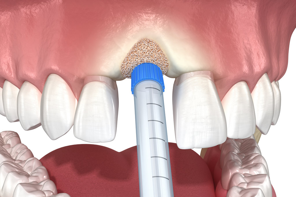 Bone grafting augmentation, socket preservation, tooth implantation. Medically accurate 3D illustration.