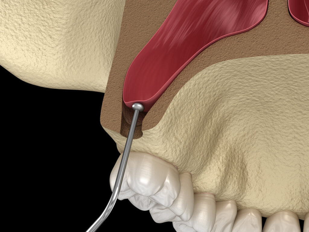 Sinus Lift Surgery - Sinus Augmentation. 3D illustration