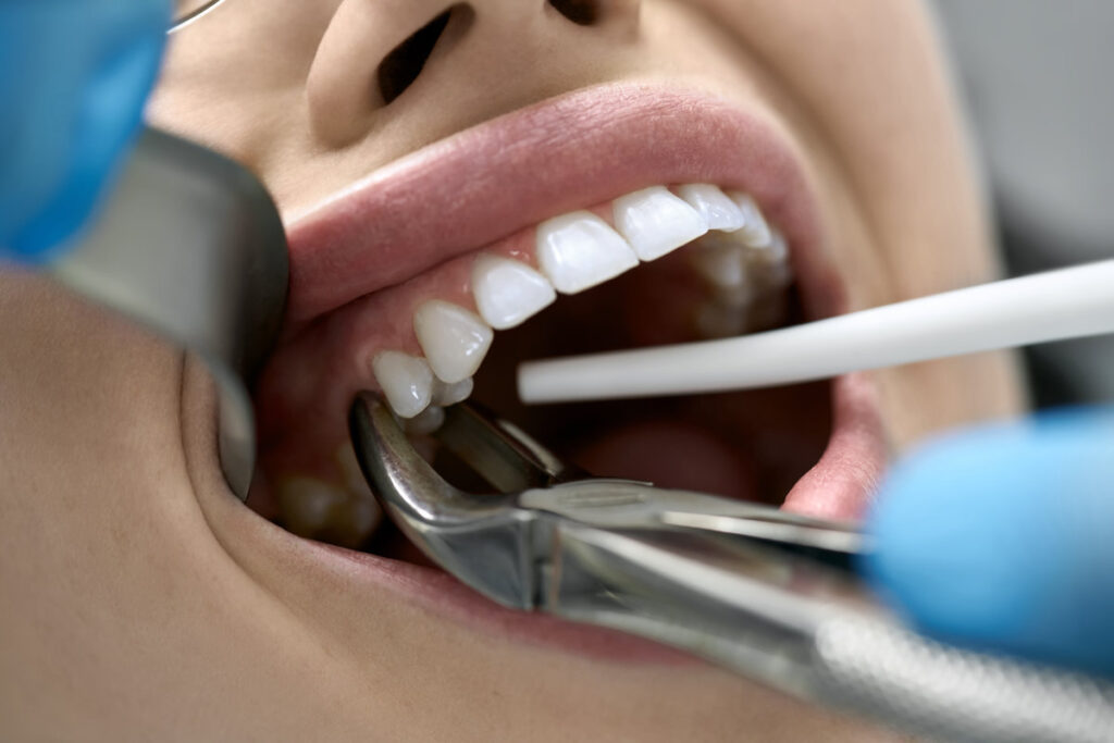 Brave girl in a dental clinic. Dentist in blue latex gloves is removing her tooth with a help of a cheek retractor and forceps. Closeup horizontal photo.