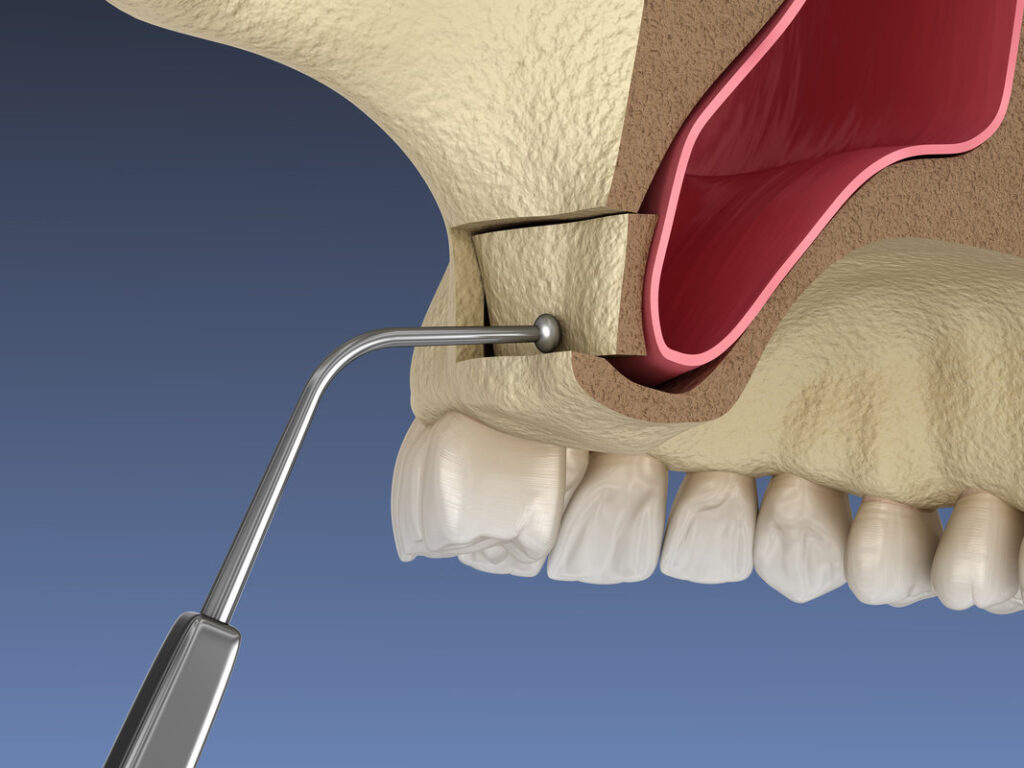 Sinus Lift Surgery - Moving sinus membrane. 3D illustration
