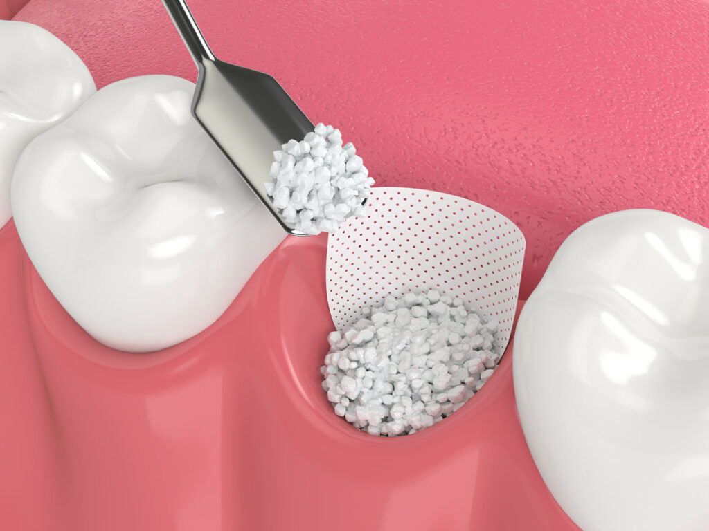 3D render of dental bone grafting with bone biomaterial and membrane over white background. Jaw bone augmentation concept.