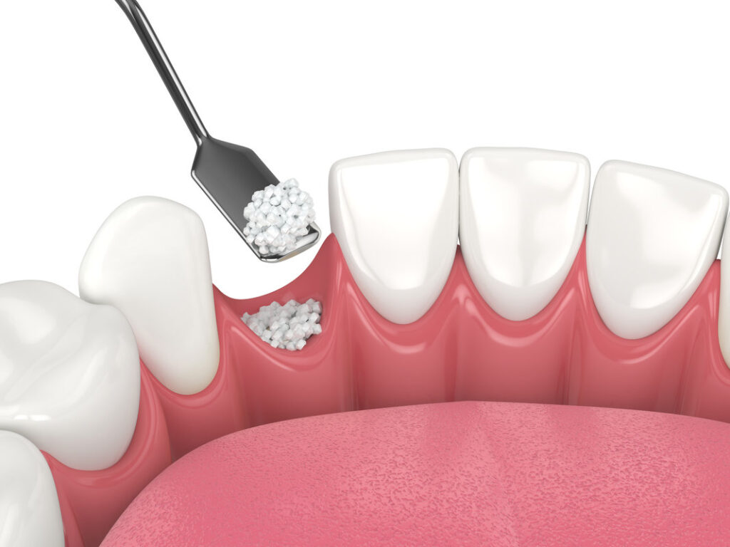 3D render of dental bone grafting with dental bone biomaterial over white background. Jaw bone augmentation procedure concept.