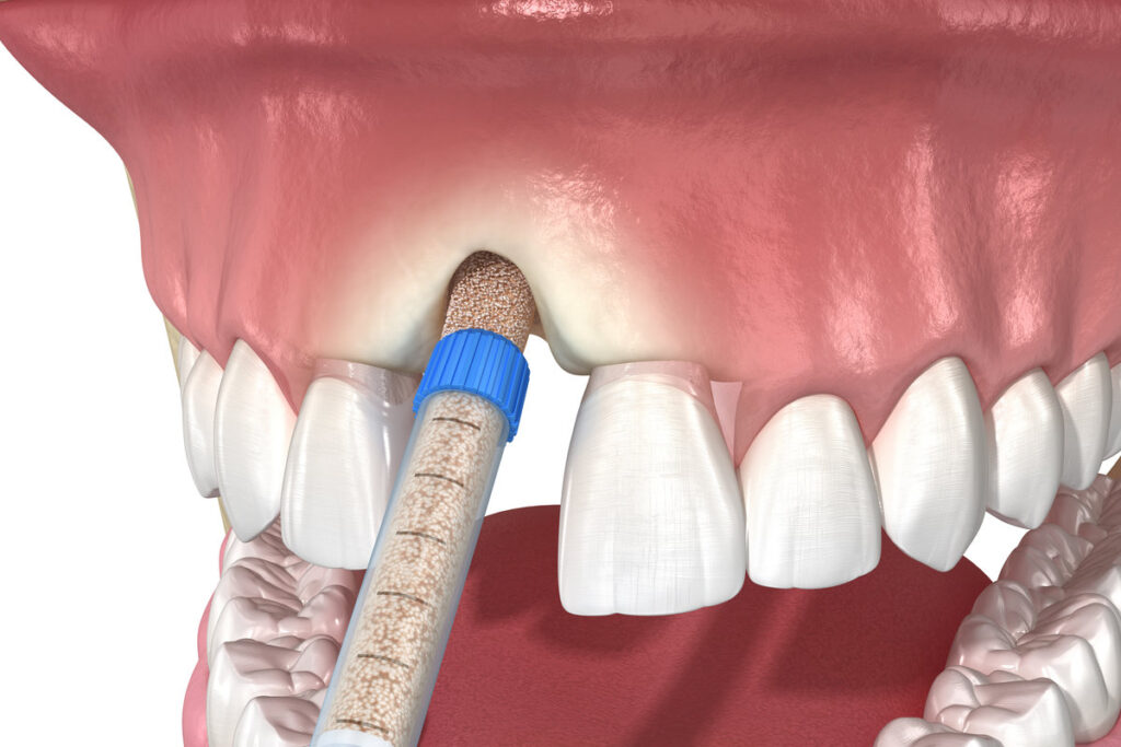 Bone grafting augmentation, socket preservation, tooth implantation. Medically accurate 3D illustration.