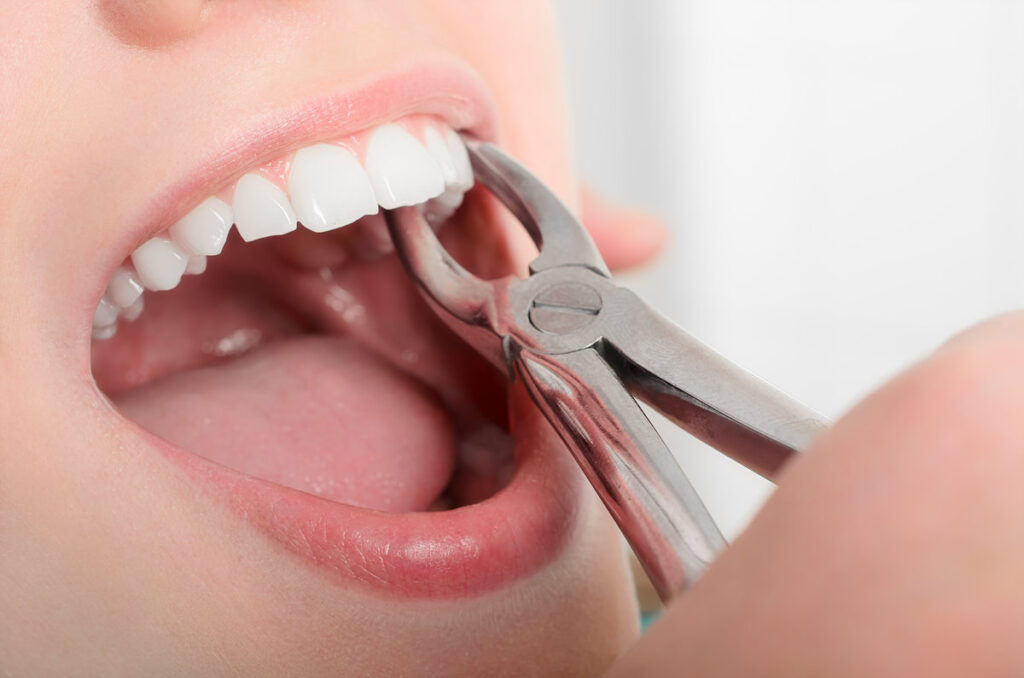 Removing the sick tooth from girls mouth